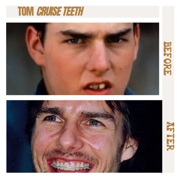 Tom Cruise Teeth Before & After The Journey, Dental Procedures, 