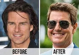 Tom Cruise Teeth Before & After The Journey, Dental Procedures, 