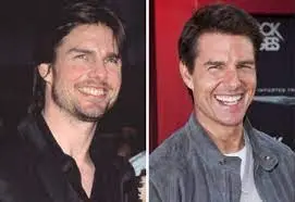 Tom Cruise Teeth Before & After The Journey, Dental Procedures, 