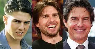 Tom Cruise Teeth Before & After The Journey, Dental Procedures, 