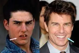 Tom Cruise Teeth Before & After The Journey, Dental Procedures, 